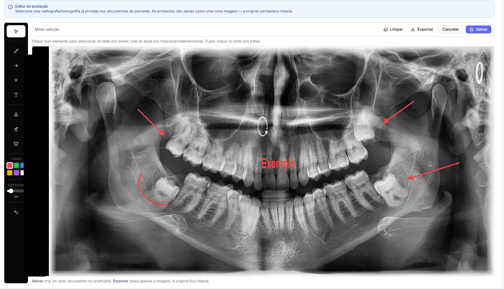 Desenhe o plano de tratamento direto sobre a radiografia